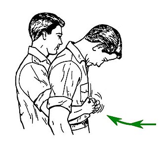 Heimlich Maneuver Published for Choking Victims, June 1, 1974