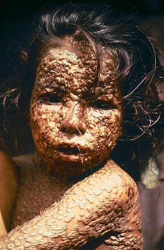 Smallpox Eradication Certified, First Human Disease Extinct December 9, 1979