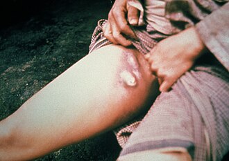 San Francisco Bubonic Plague Case in Chinese Immigrant, February 7, 1900