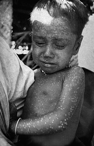 Rahima Banu, Last Natural Smallpox Case in Bangladesh, October 16, 1975