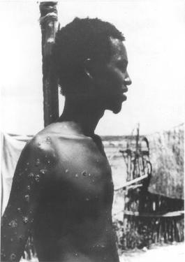 Last Natural Smallpox Case in Somalia Rash Appears October 26, 1977